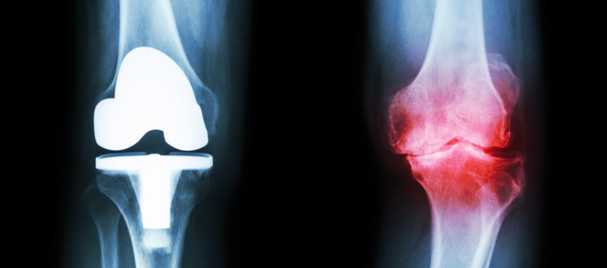 knee-osteoarthritis-1200x900 (2)